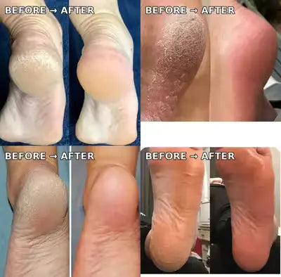 Electric Pedicure Foot File & Callus Remover